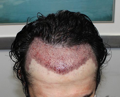 HAIR TRANSPLANT
