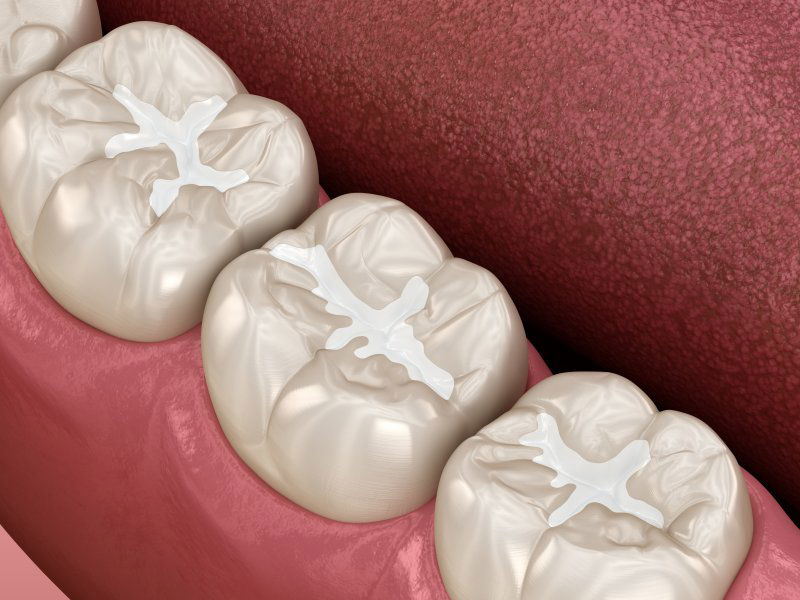 Tooth Filling Cost in Dubai
