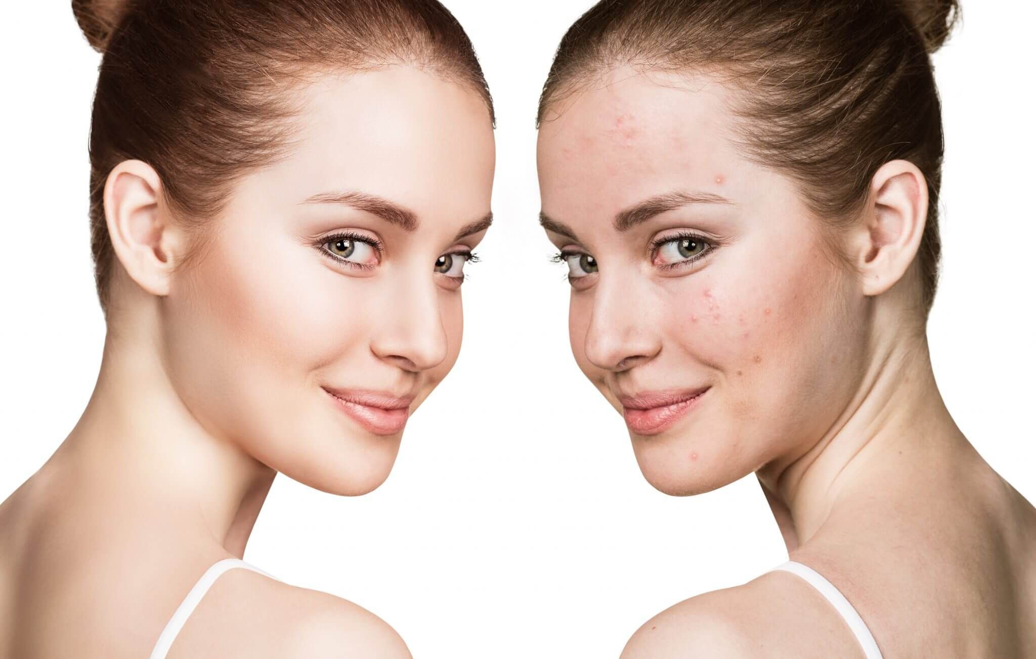 Cold Peel