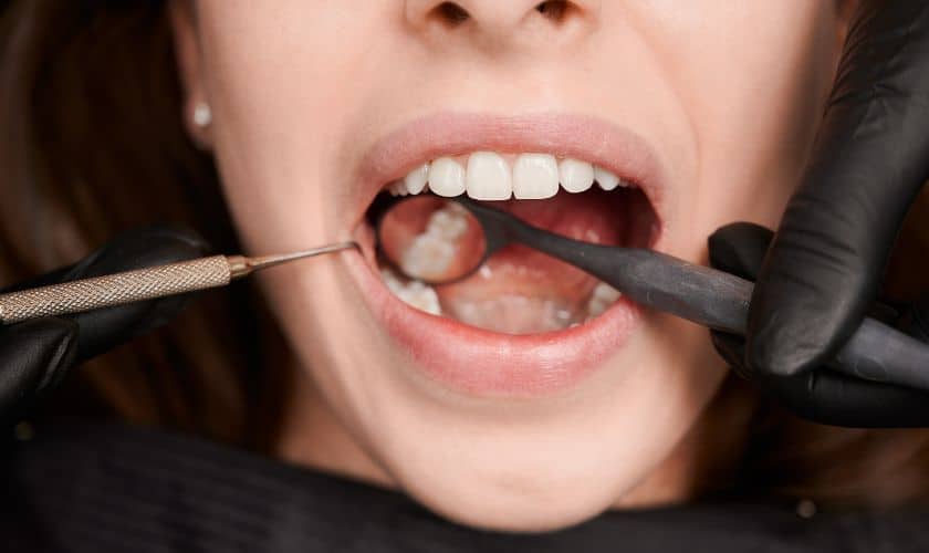 Tooth Filling