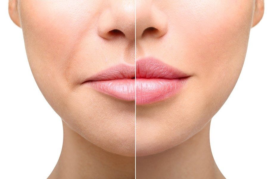 Juvederm Fillers