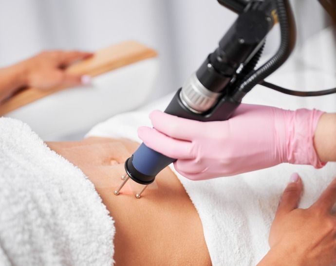 Laser Stretch Marks Treatment