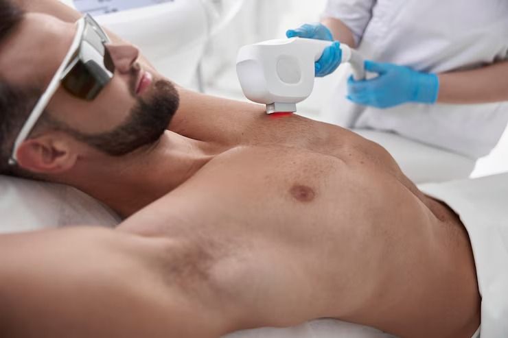 Male Laser Hair Removal