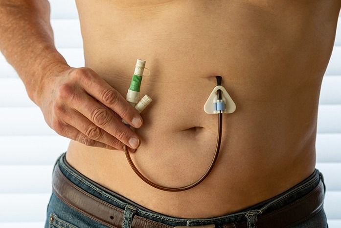 Tube Feeding at home
