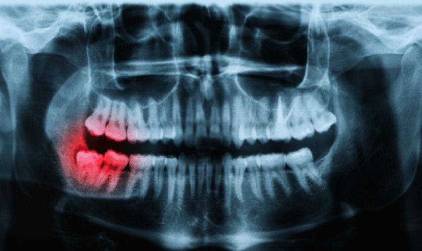 Panoramic Dental X-Ray