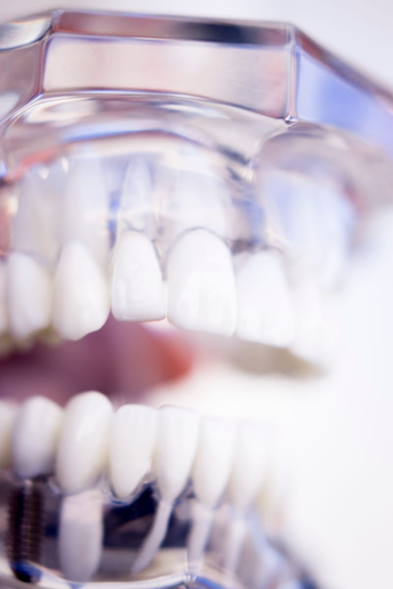 Implantes Dentales
