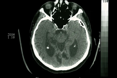 Scoperti nuovi bersagli farmacologici per l'Alzheimer