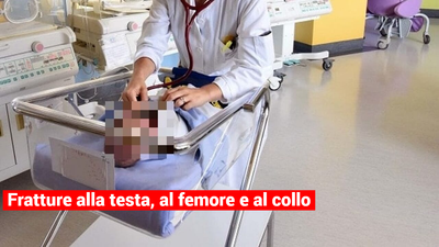 Bimbo di 9 mesi in ospedale ha diverse fratture; femore collo testa