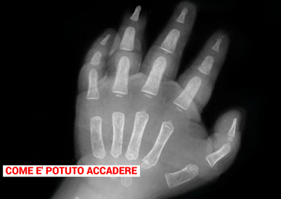 Mano nel tritacarne, ricostruito un dito a una bimba di 18 mesi