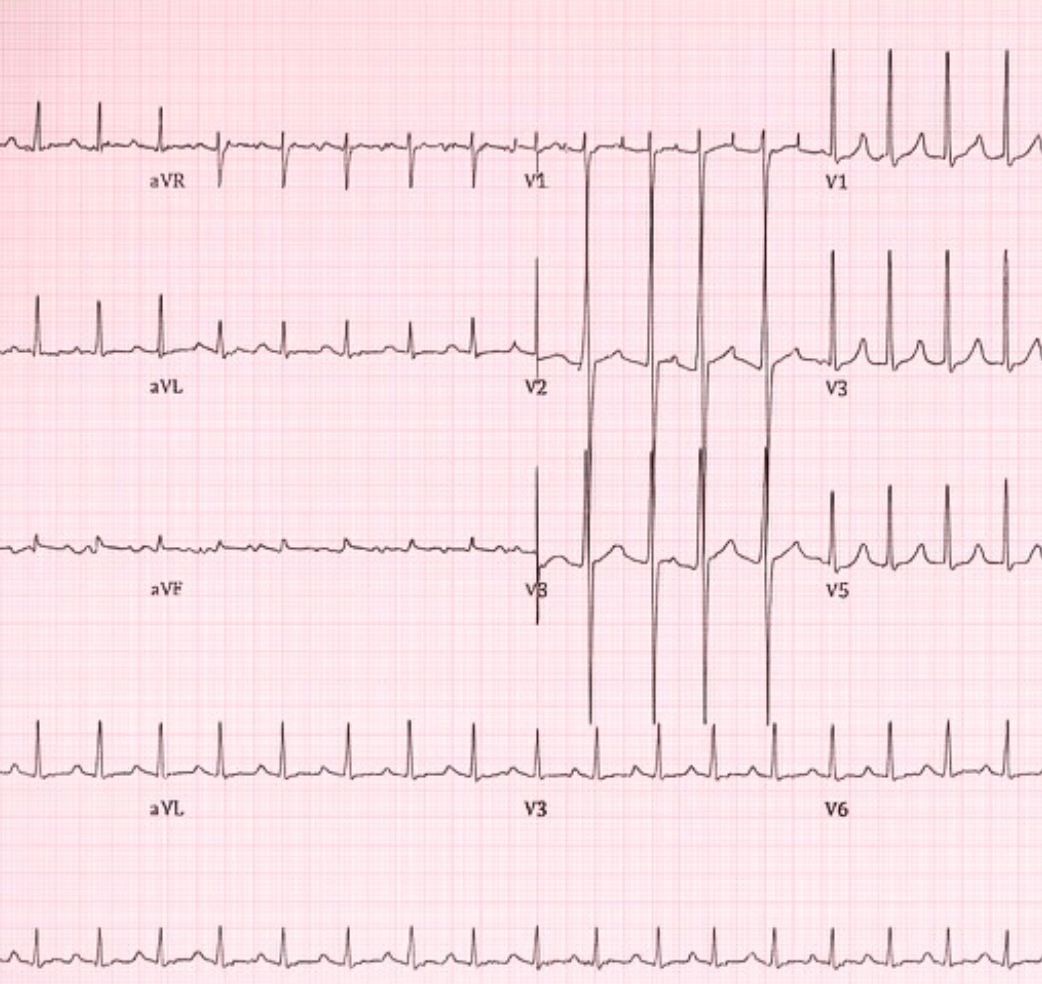 Acute Aortic Dissection in Heritable Thoracic Aortic Disease: Loeys–Dietz Syndrome with TGFBR2 Mutation