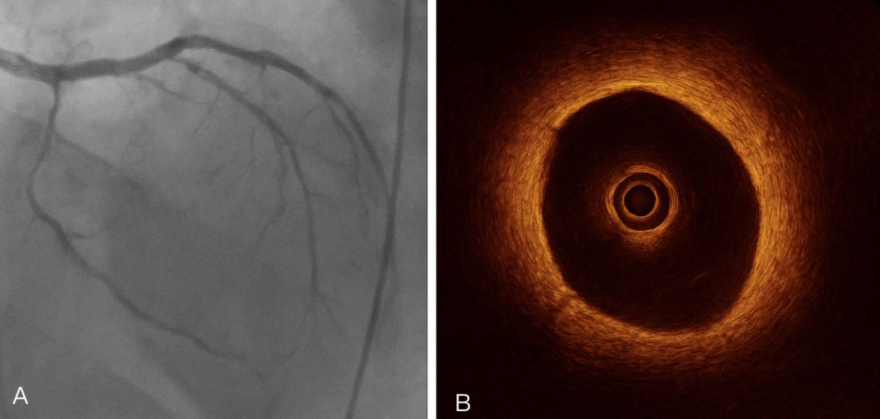 Spontaneous Coronary Artery Dissection in a Young Woman Presenting with Acute Myocardial Infarction