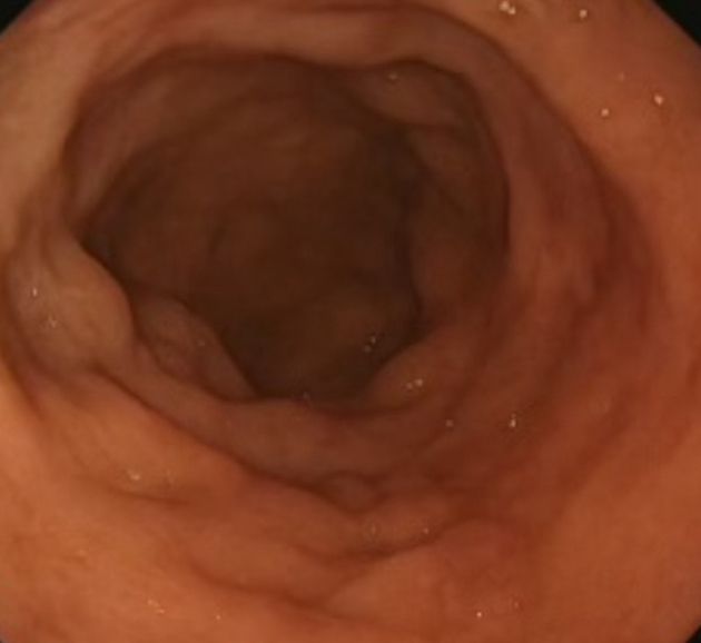 Sustained Glycaemic Improvement After Duodenal Mucosal Resurfacing in Type 2