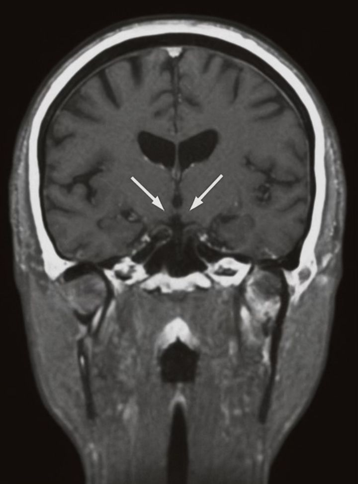 Deep Brain Stimulation of the Subcallosal Cingulate in Severe Anorexia Nervosa: Perioperative Management