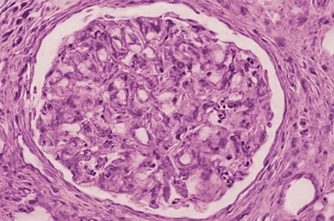 Early Rituximab-Based Immunosuppression for Recurrent FSGS Post-Kidney Transplant: Implications for Perioperative Management