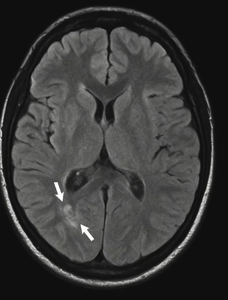 Anti-NMDA Receptor Encephalitis Initially Misdiagnosed as Psychiatric Illness: Implications for Perioperative and Critical Care Management