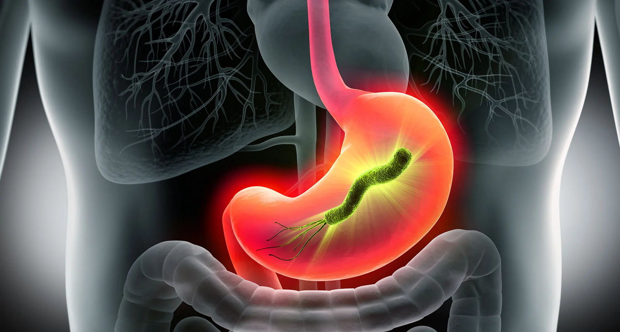 Helicobacter pylori Infection and Irritable Bowel Syndrome: A Systematic Review and Meta-Analysis With a Narrative Review of the Evidence for Inflammatory Bowel Disease