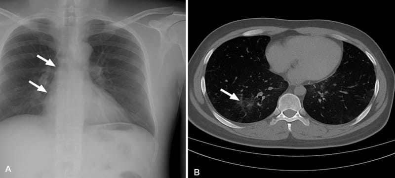 Atypical Presentation of Multidrug-Resistant Acinetobacter baumannii Pneumonia in a Post-Surgical ICU Patient: A Case Report