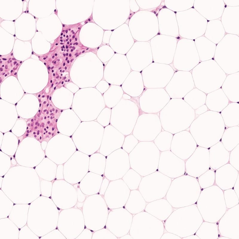 Paraspinal Extramedullary Hematopoiesis in a Transfusion-Dependent Beta-Thalassemia Patient: A Case Report