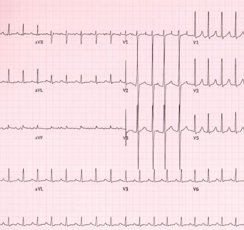 Acute Aortic Dissection in Heritable Thoracic Aortic Disease: Loeys–Dietz Syndrome with TGFBR2 Mutation