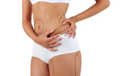 A Complete Guide to Liposuction Recovery in Islamabad