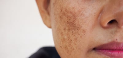 Chemical Peels for Melasma in Islamabad – Are They Effective?