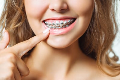 What to Expect During Your First Braces Consultation in Islamabad