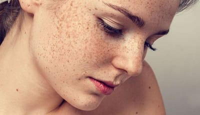 Fractional CO2 vs. Q-Switched Laser for Melasma: Which One Is Right for You?