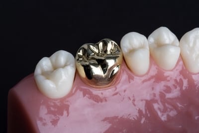 Affordable Dental Bridges in Islamabad: Where to Go & What to Know