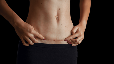 Who Is the Ideal Candidate for Abdominoplasty in Islamabad?