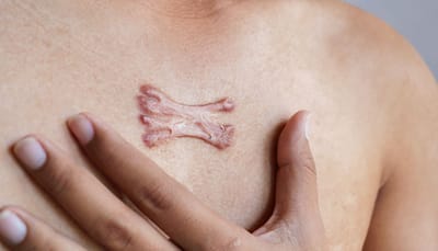The Islamabad Keloid Guide: Your Path to Smoother Skin