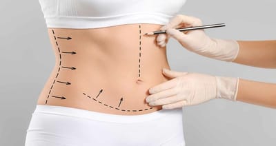 Which areas of the body can be treated with liposuction?