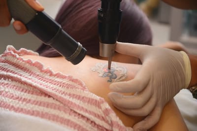 Tattoo Removal for Large Tattoos in Islamabad: Cost & Time Guide