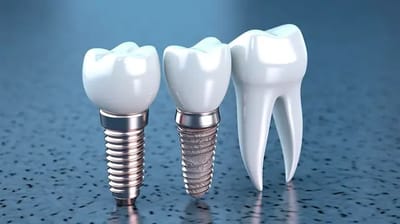Dental Implants Market in India: Size, Share, Growth Rate, Analysis & Industry Report 2025-2033
