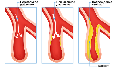 Чем опасна артериальная гипертензия (гипертония)