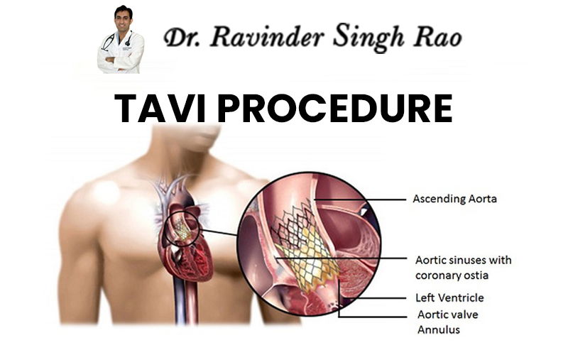 Transcatheter Aortic Valve Implantation