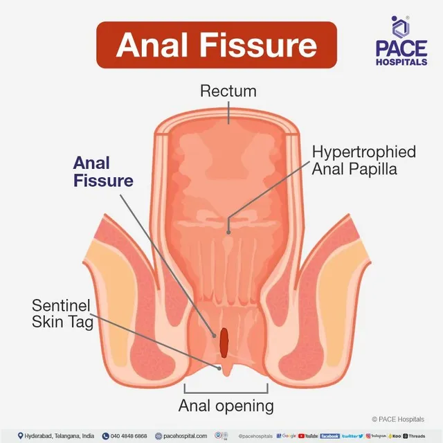 Anal Fissure
