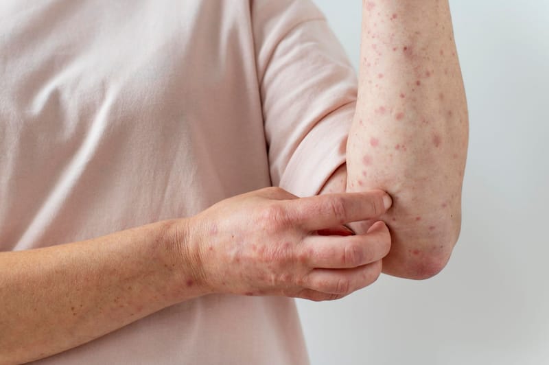 Alerta preventiva por sarampión en el norte de Chile: Dr. Pedro Astudillo de Clínica INDISA entrega recomendaciones ante riesgo de contagio