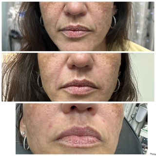 Botox & Filler Injections