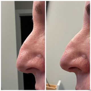 Botox & Filler Injections