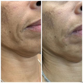 Botox & Filler Injections