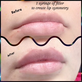 Botox & Filler Injections