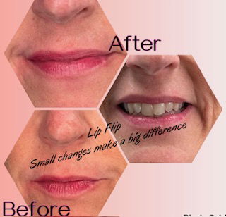 Botox & Filler Injections