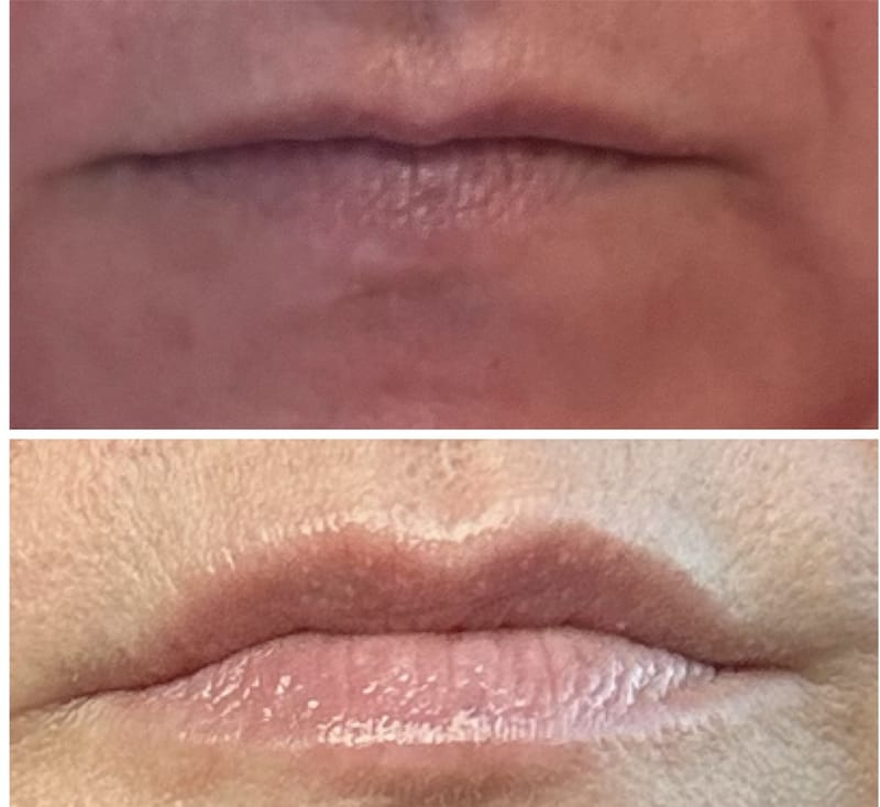 Botox & Filler Injections