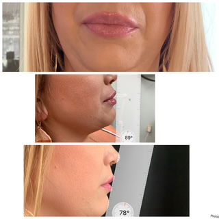 Botox & Filler Injections