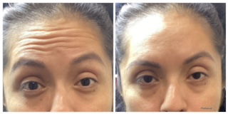 Botox & Filler Injections
