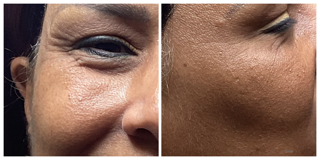 Botox & Filler Injections