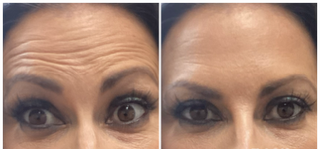 Botox & Filler Injections