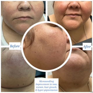 Microneedling Treatments