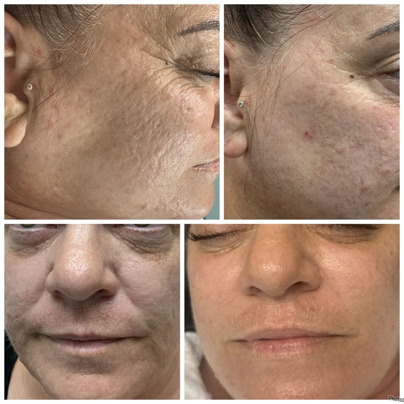 Microneedling Treatments