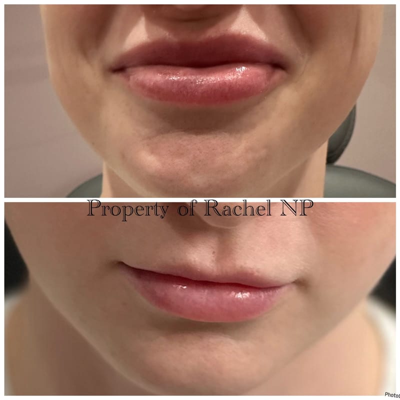 Botox & Filler Injections